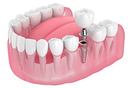 Illustration of single dental implant being placed on lower teeth