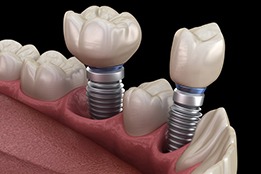 a 3D illustration of two dental implants in the jawbone