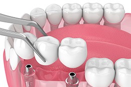 Illustration of implant bridge being placed on lower teeth