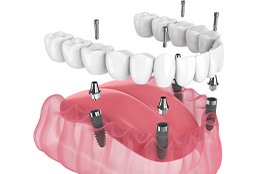 Illustration of implant denture being placed on lower teeth