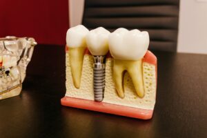 Model of titanium dental implant